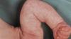 „Marmurinė“ kūdikių oda: norma ar patologija? Neurologas atsako