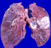 Plaučių vėžys: kaip nepraleisti ligos pradžia?