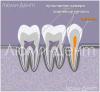 Kaip rasti ir gydyti dantų kanalus Lumidente