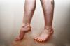 Pažeidimas kraujotaka kojose: priežastys, simptomai