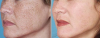 Geriausias vaistas nuo pigmentacijos ant veido, kaklo ir iškirptės srities. Poveikis yra pastebimas iš karto po 1 naudojimo
