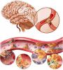 Smegenų aterosklerozė: kaip elgtis, kas yra simptomai?