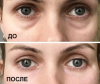 Vienas pigus kaukė 40 rublių korekcija ašarų nosies grioveliai: rezultatas po pirmojo prašymo. Kosmetologė nebereikalingas