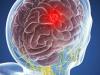 Smegenų auglys: 5 simptomai, kurie negali būti ignoruojami