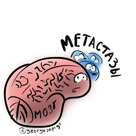 metastazių smegenyse