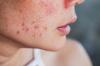 Kaip sutvarkyti odą po vasaros: procedūros namuose ir salone