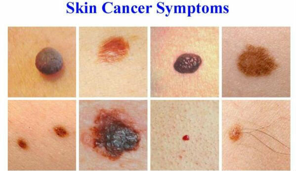 Simptomai odos vėžio