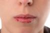 5 patarimai, kaip išvengti skeldėjimą lūpų